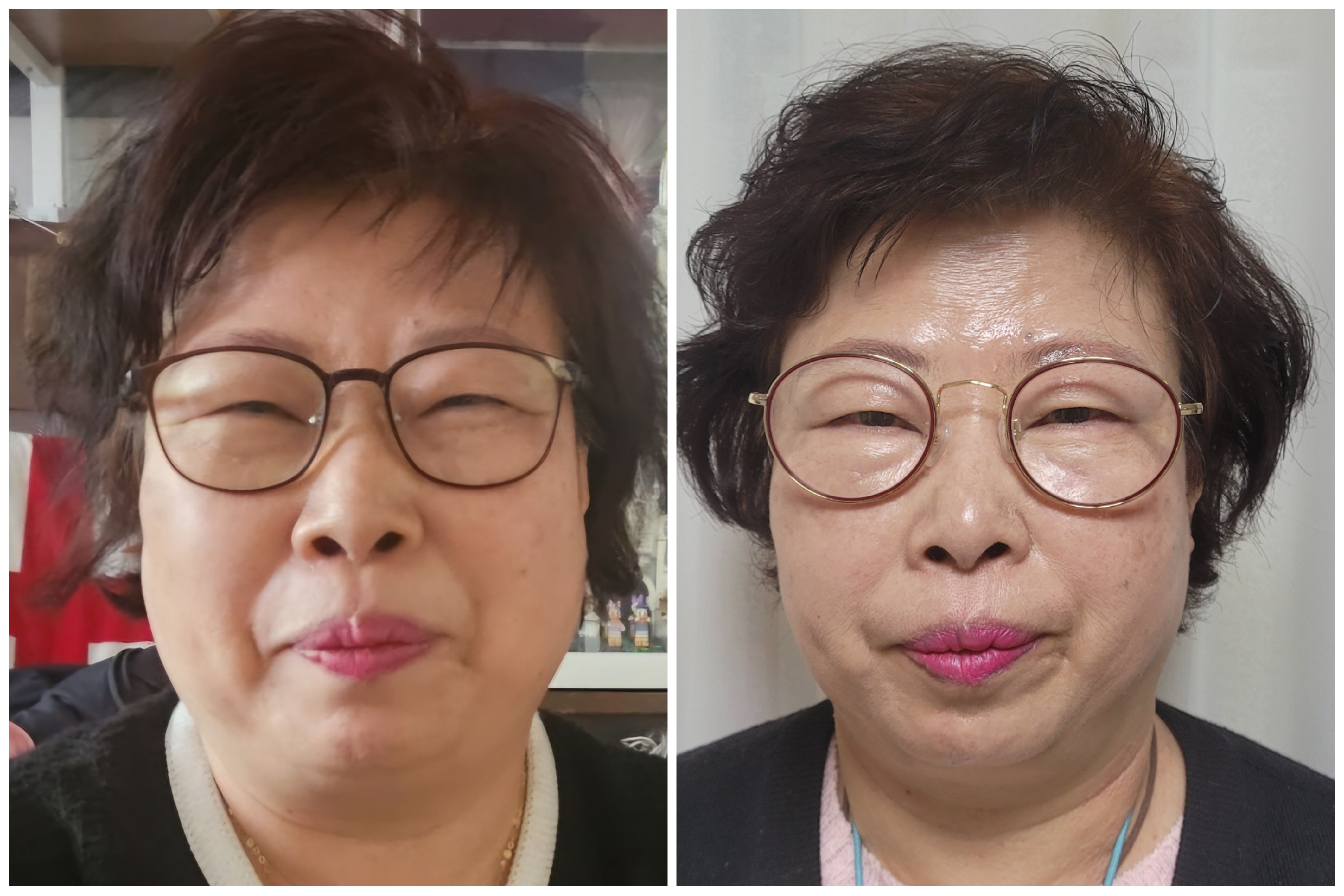 황미미루 10개월 섭취 후 놀라운 몸의 변화